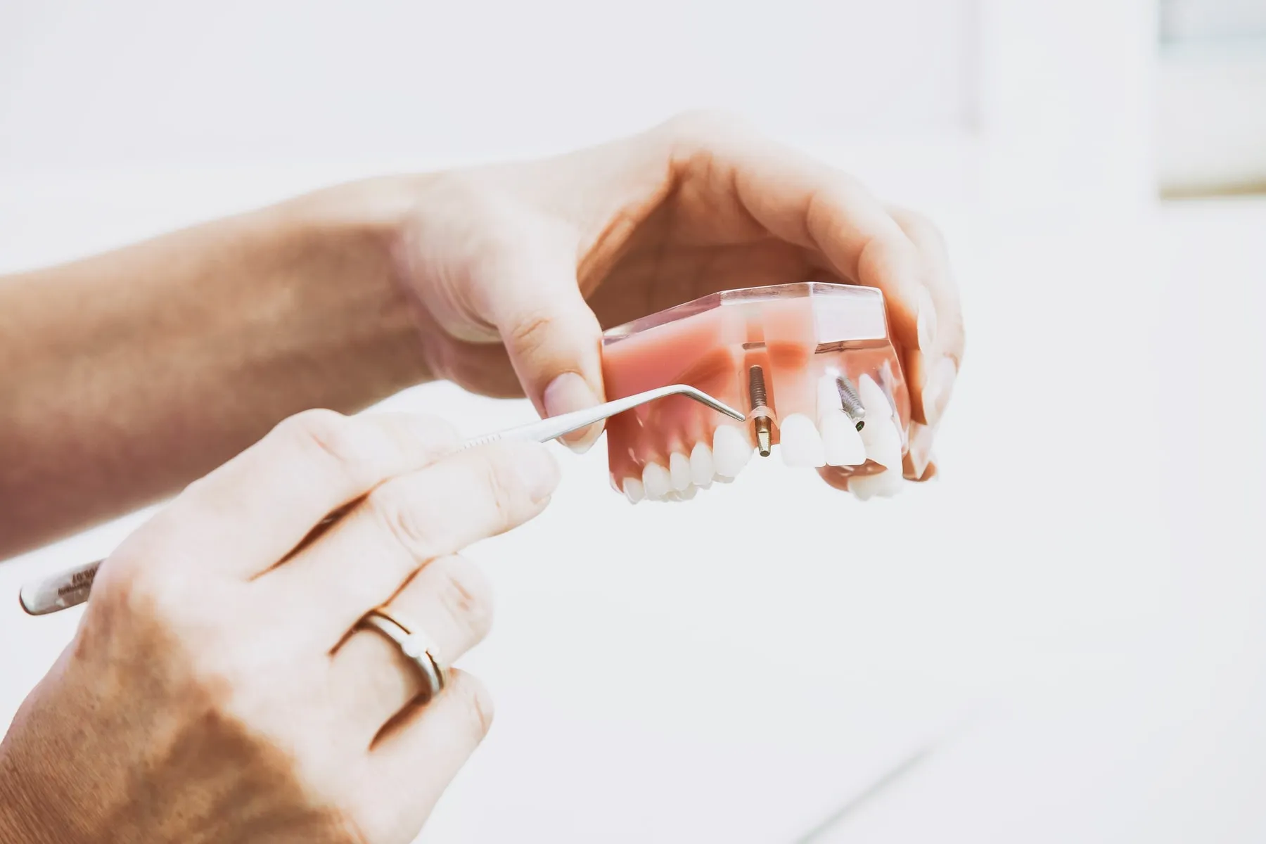 Démonstration d'un implant sur un modèle de mâchoire transparent tenu en main.
